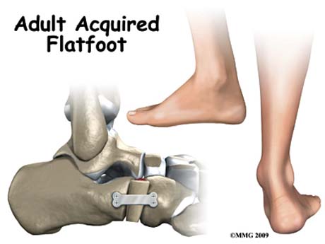 osteotomy flatfoot foot column lateral lengthening goudelis deformation correction calcaneus reach possible far